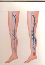 L’apport de la chirurgie par laser dans le traitement des varices