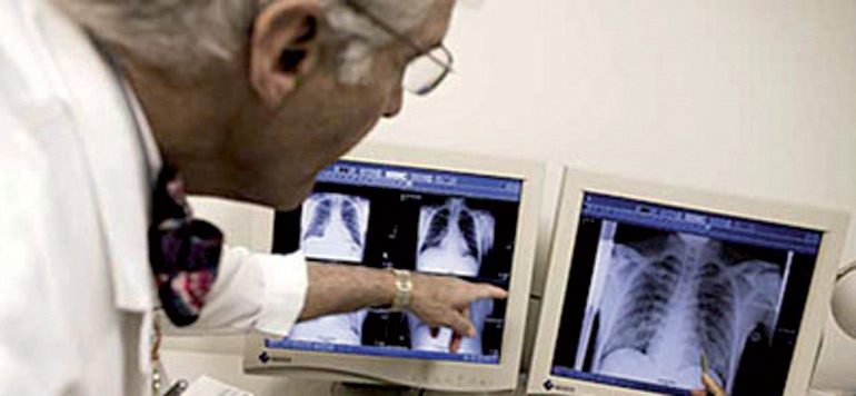 La tuberculose en ligne de mire