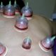 saignee hijama sante