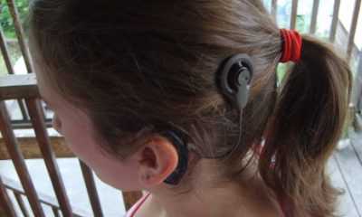 Cochlear implant2