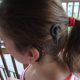 Cochlear implant2